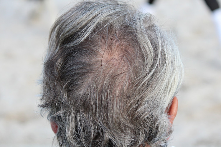 Scientists Finally Figure Out Why Stress Turns Hair Grey