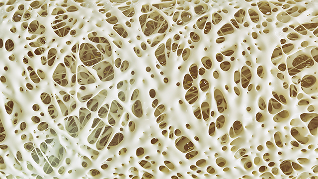 Osteoporosis myths DEBUNKED: Truths about bone health
