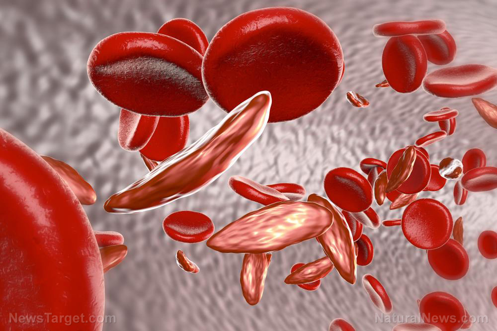 MEDICAL BOMBSHELL: Blood doctor releases findings showing Moderna’s mRNA Covid vaccines change red blood cells from round to tubular, causing them to stick together