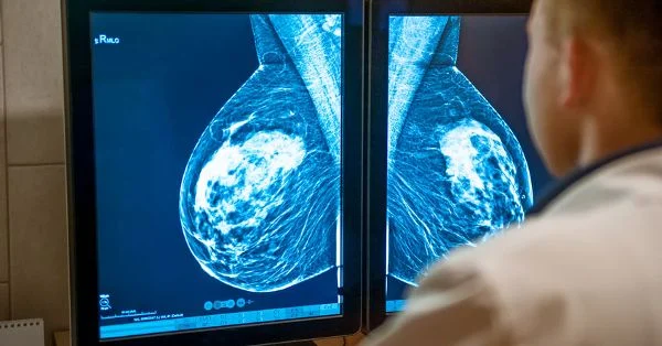 Mammograms Lead to 84% Higher Breast Cancer Death Rates After False-Positives , JAMA Oncology Reveals